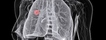 Artificial Intelligence improves detection of deadly lung cancer.